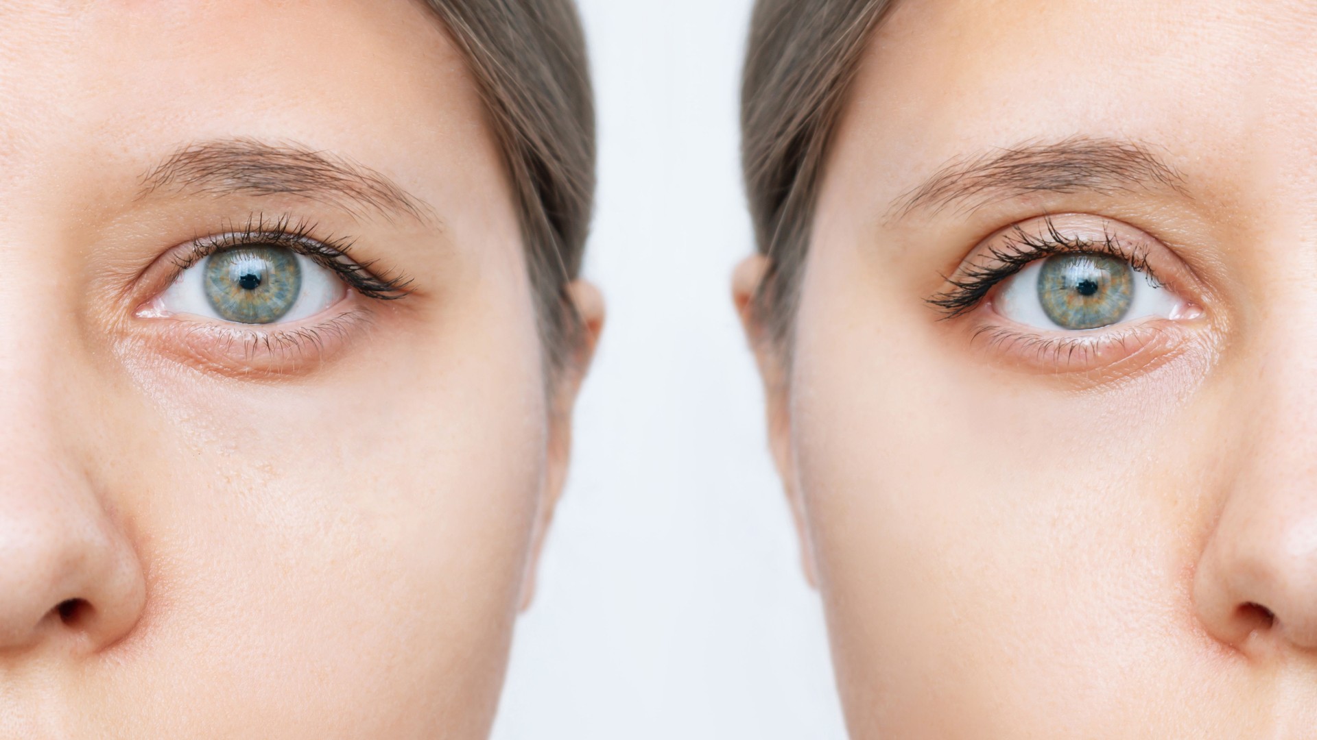 Close up of young caucasian woman's face with drooping upper eyelid before and after blepharoplasty